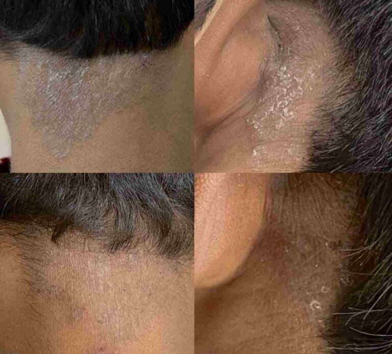 psoriasis laser treatment, Neo Elite laser, psoriasis breakthrough India, non-invasive psoriasis care